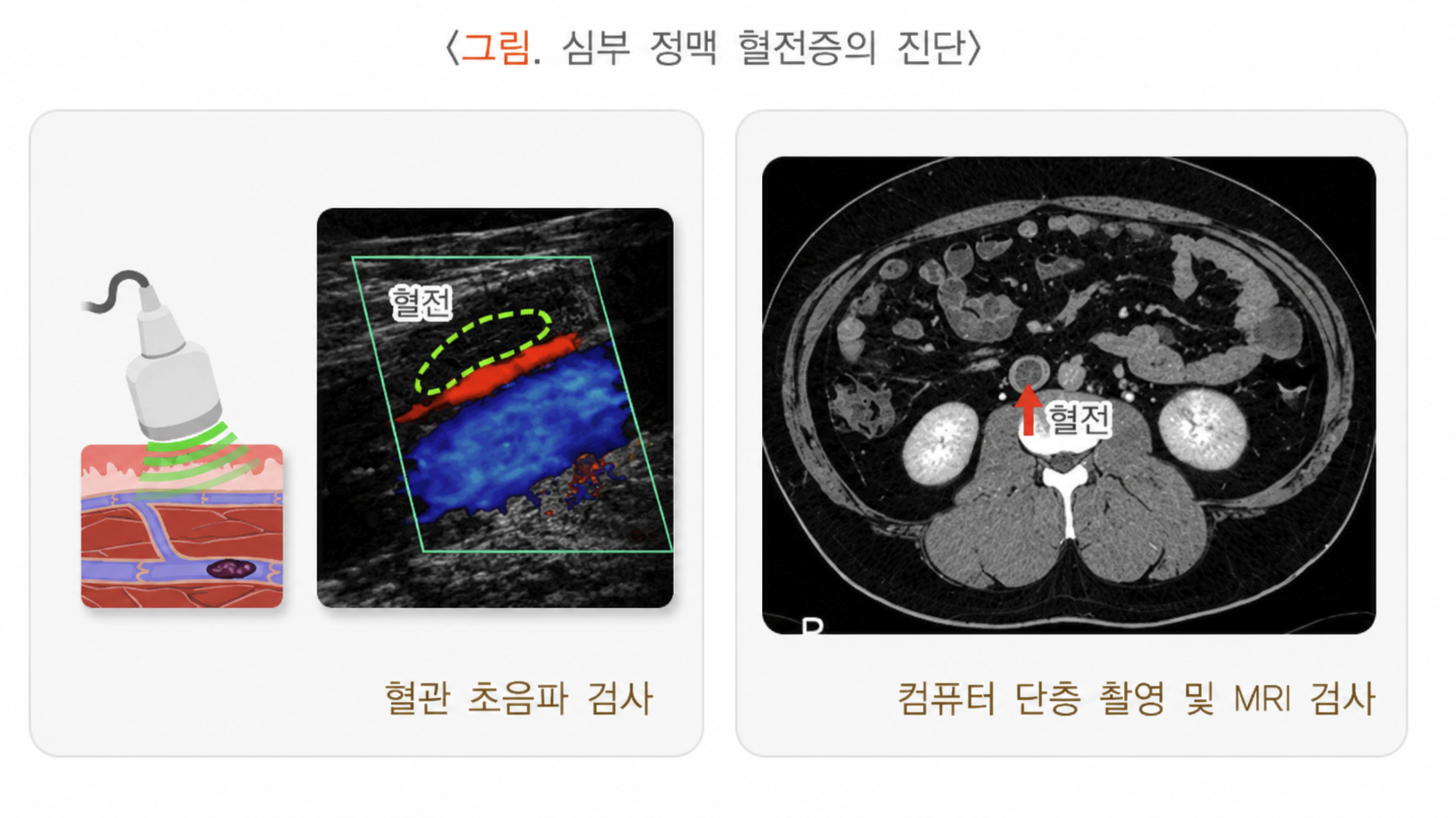 하지 심부 정맥 혈전증 진단을 위한 압박 혈관 초음파 검사(왼쪽)와 조영제 컴퓨터단층촬영(오른쪽)